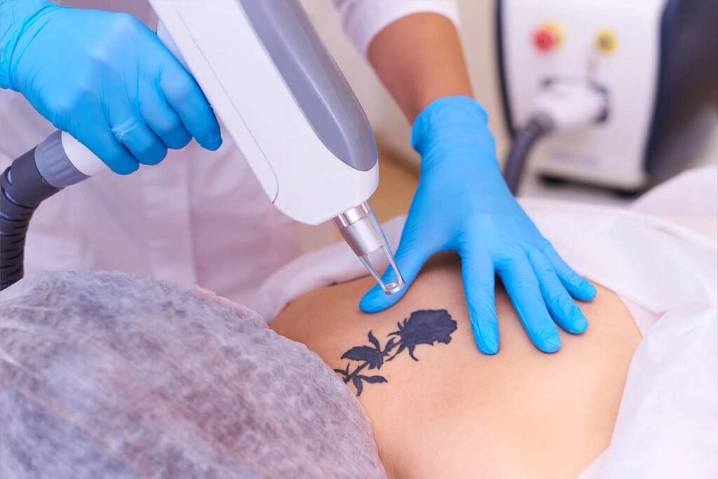Tattoo Removal Treatment in Pune