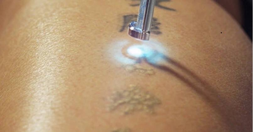 Tattoo Removal